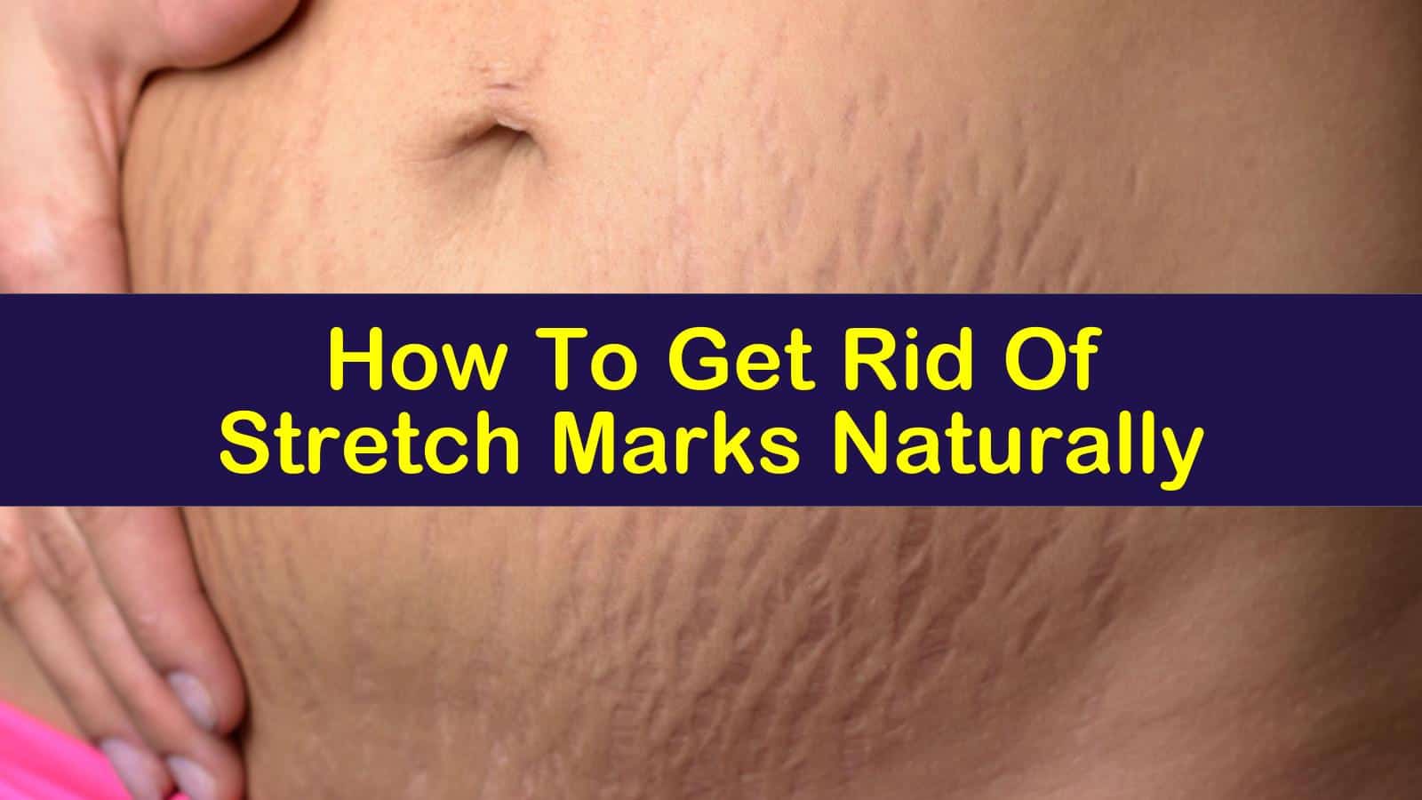 can you get rid of stretch marks